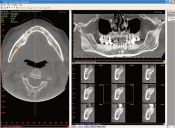 tac-implant_mandible.jpg