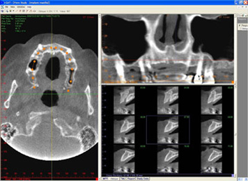 tac-implant_maxilla.jpg