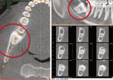 tac-implant_molar.jpg